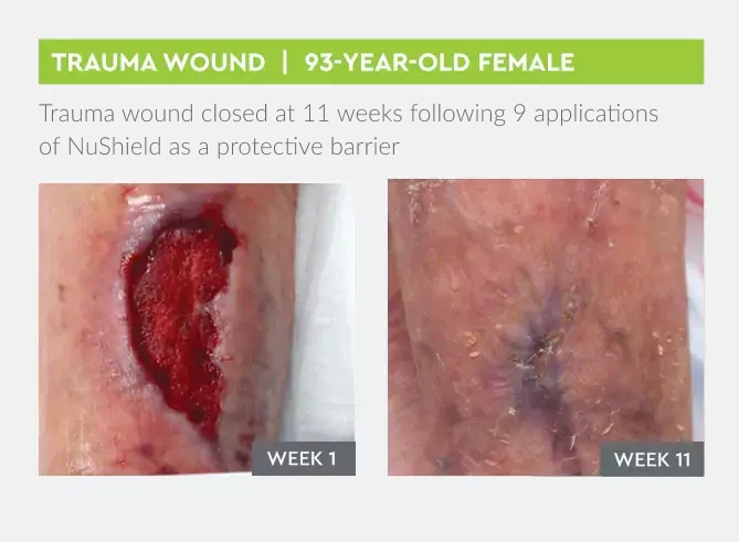 Trauma wound closed at 11 weeks following 9 applications of NuShield as a protective barrier